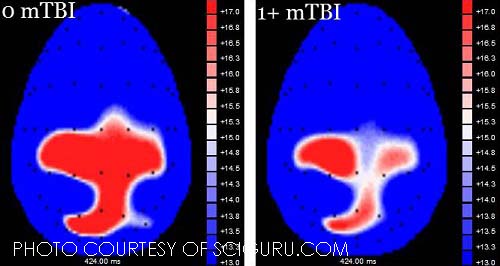 Concussions present greater threat to athletes