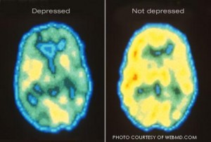 Brain PET scans showing the activity levels of someone with and without depression; the yellow represents brain activity. Many view depression as not a disease, which serves to further stigmatize and isolate those suffering.