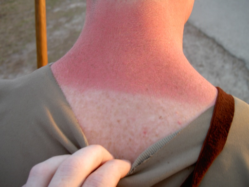 All About Sunburns: Risks, Prevention, and Treatment